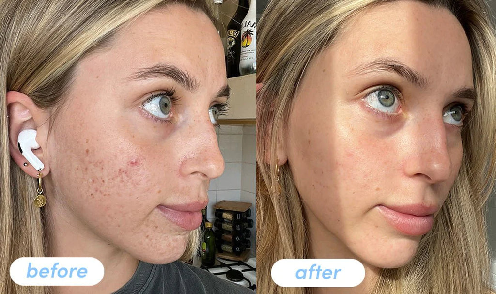 glutathione supplementation and skin pigmentation laser hair removal Nutrione BB LAB Glutathione Collagen W glutathione supplementation and skin pigmentation laser hair removal Nutrione BB LAB Glutathione Collagen W